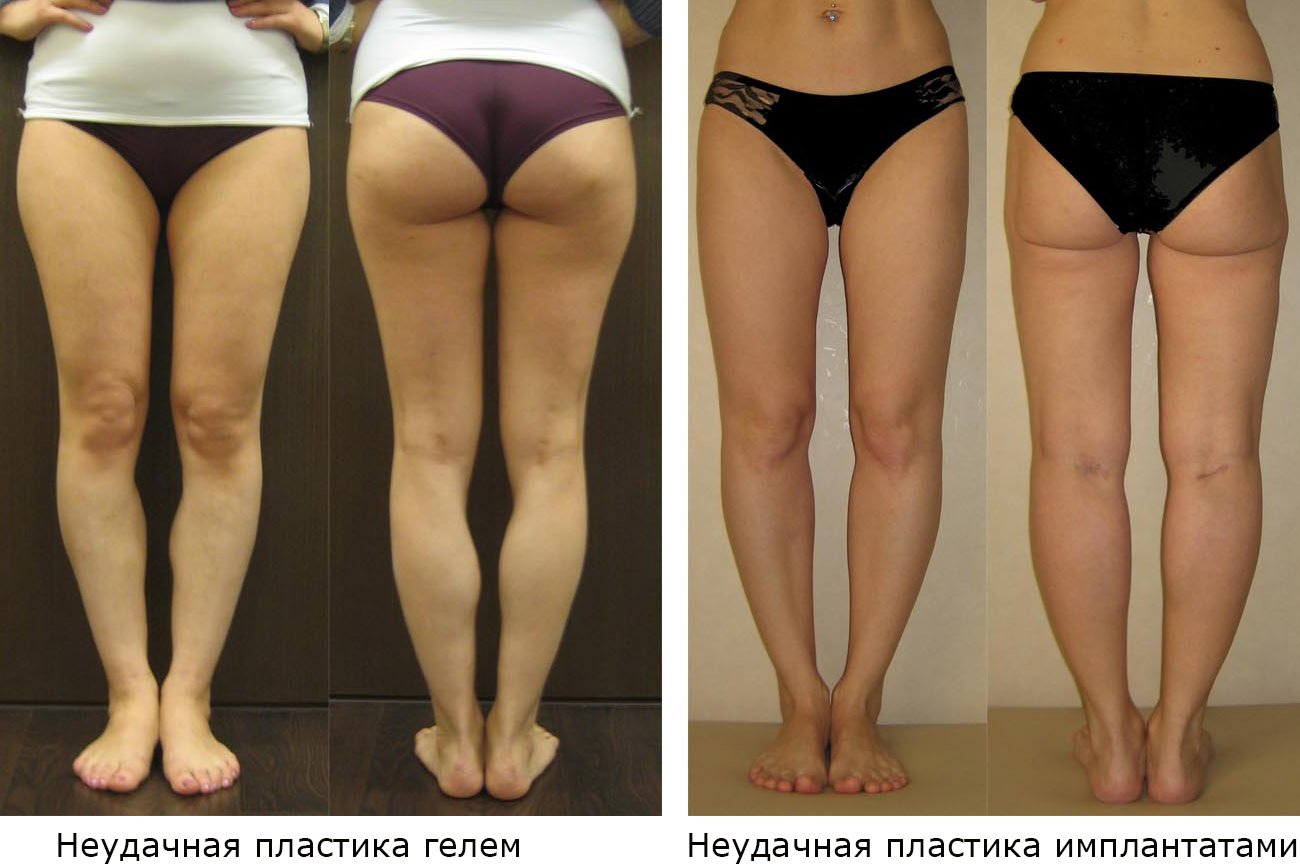 Неудачные результаты контурной пластики