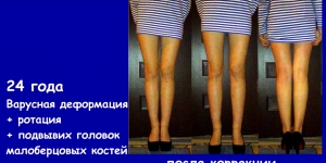 Видео доктора «Исправление кривизны и удлинение ног»